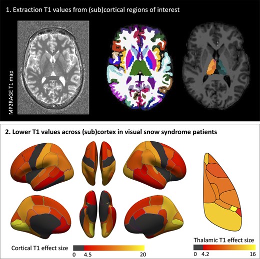 VSI-Funded Monash Study: “Microstructure in Patients with Visual Snow Syndrome: An Ultra-High Field Morphological and Quantitative MRI Study”